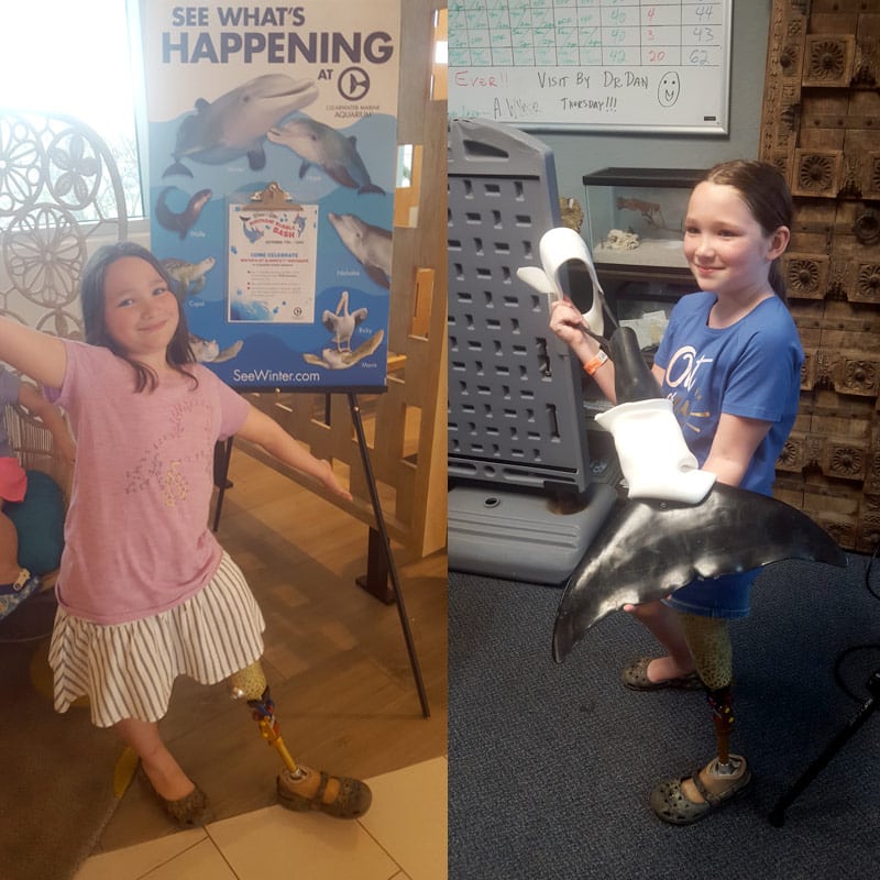 Leya leg amputee with dolphin tale prosthetics